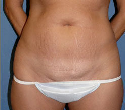 Abdominoplasty before and after - before