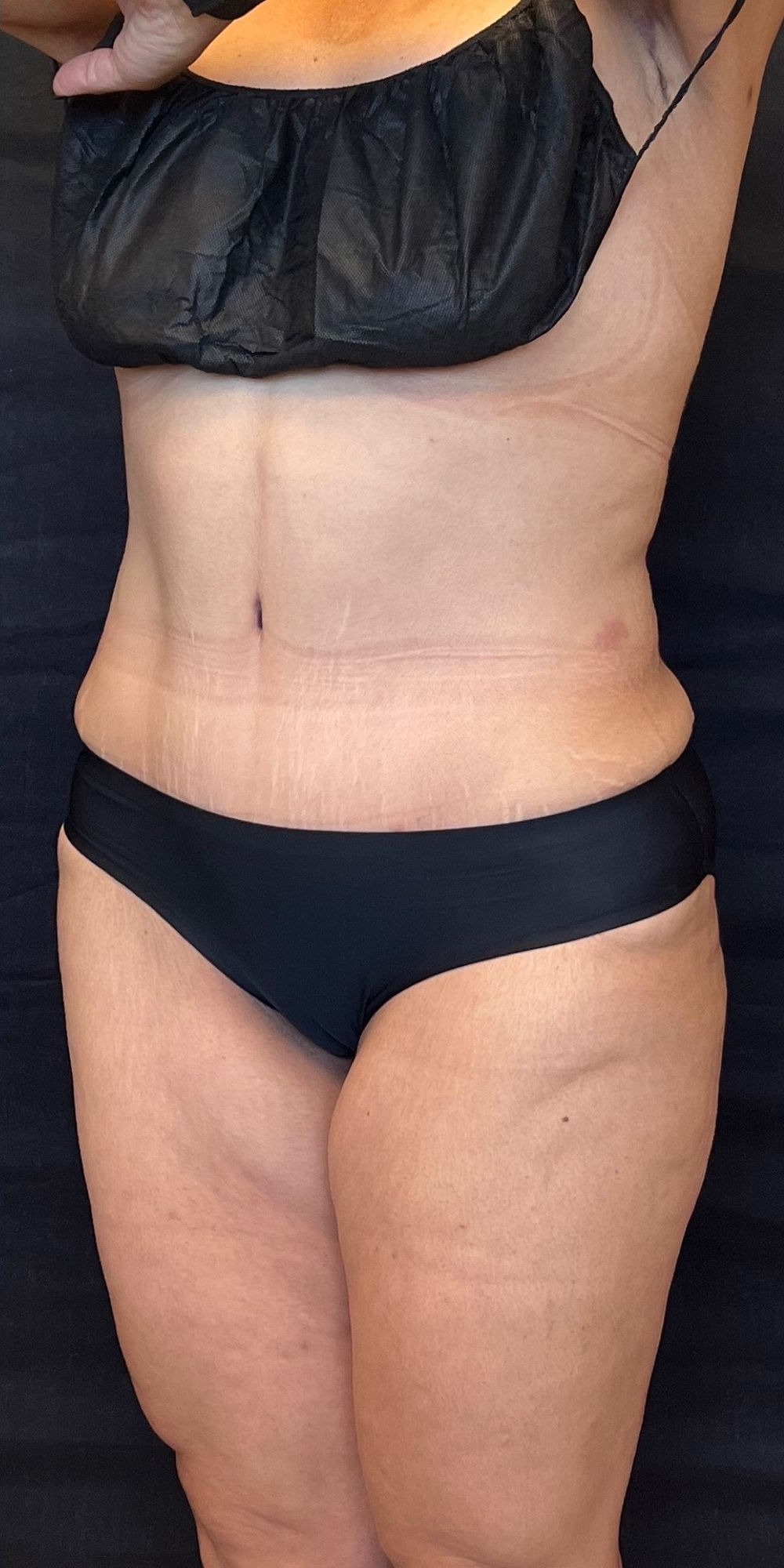 Mommy Makeover before and after - after