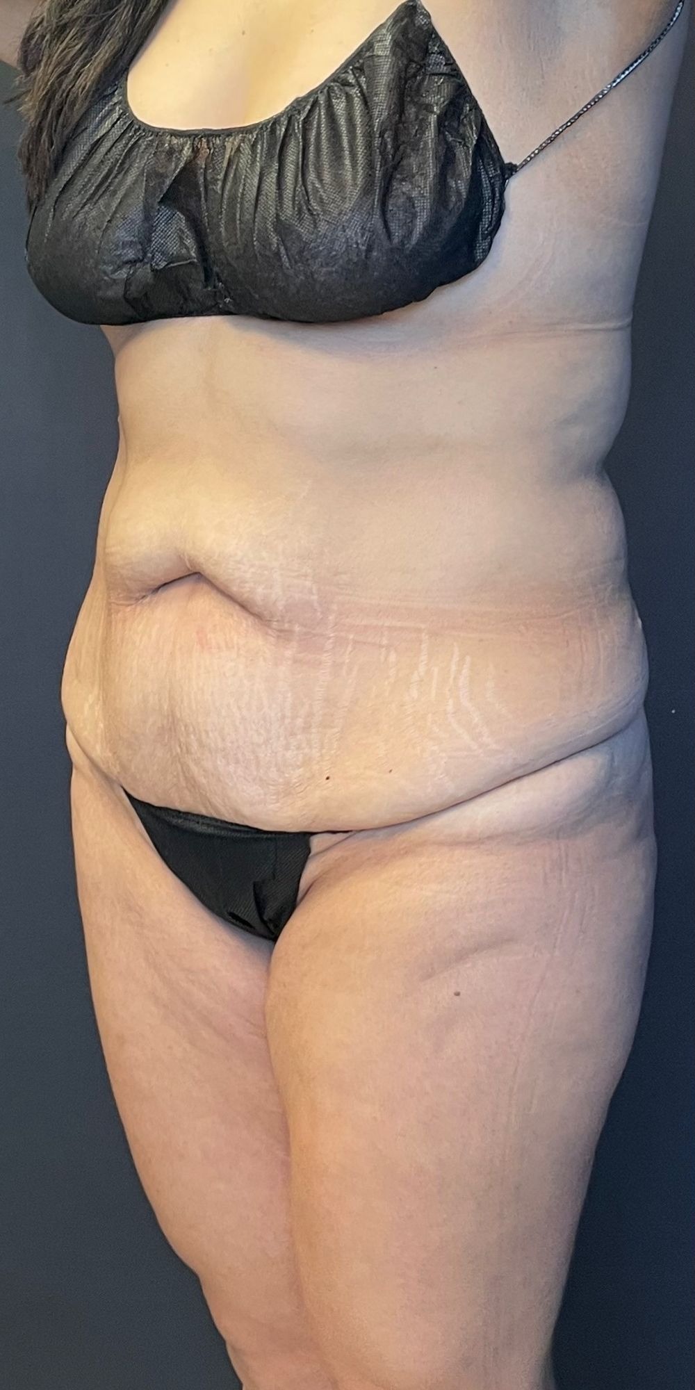 Mommy Makeover before and after - before