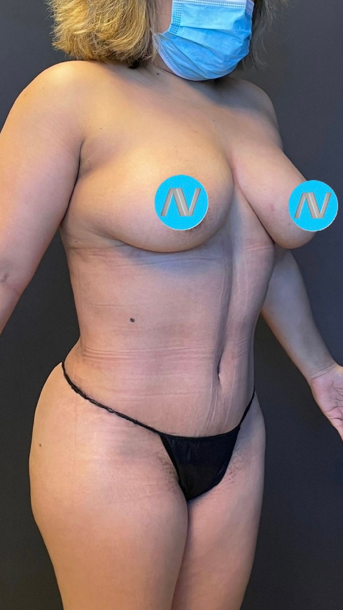 Breast Lift before and after - after
