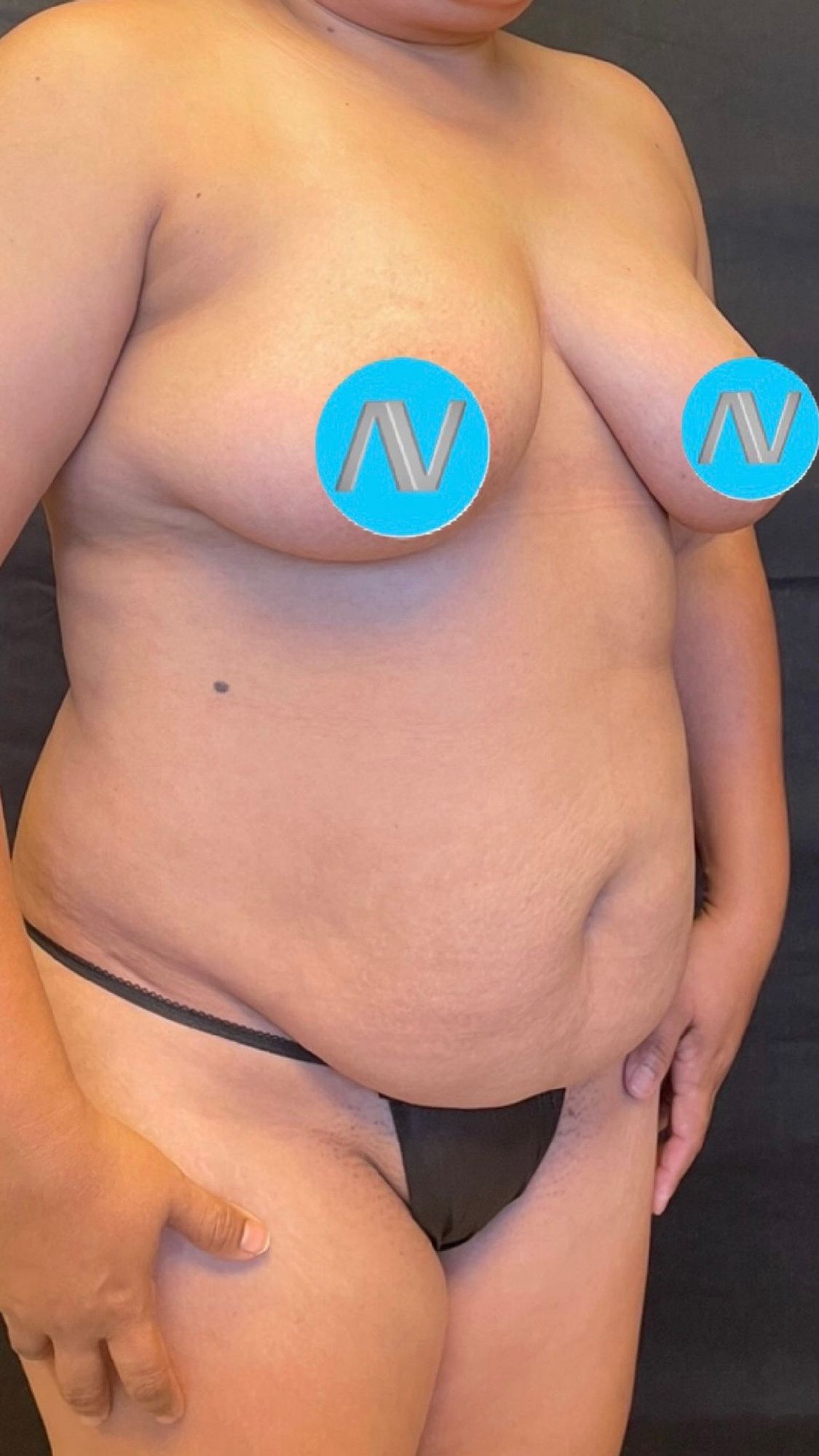 Breast Lift before and after - before