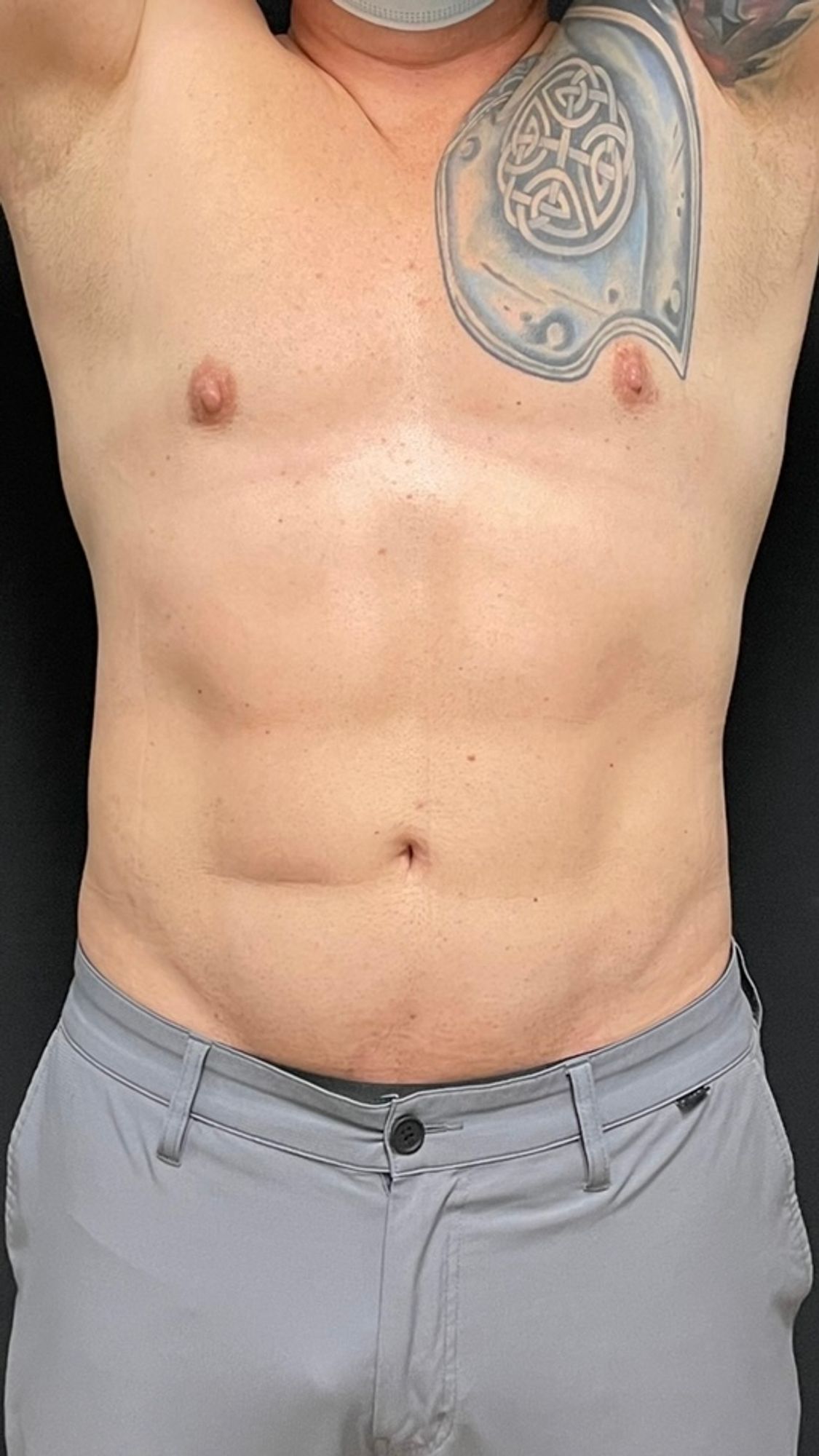 Body Contouring before and after - after