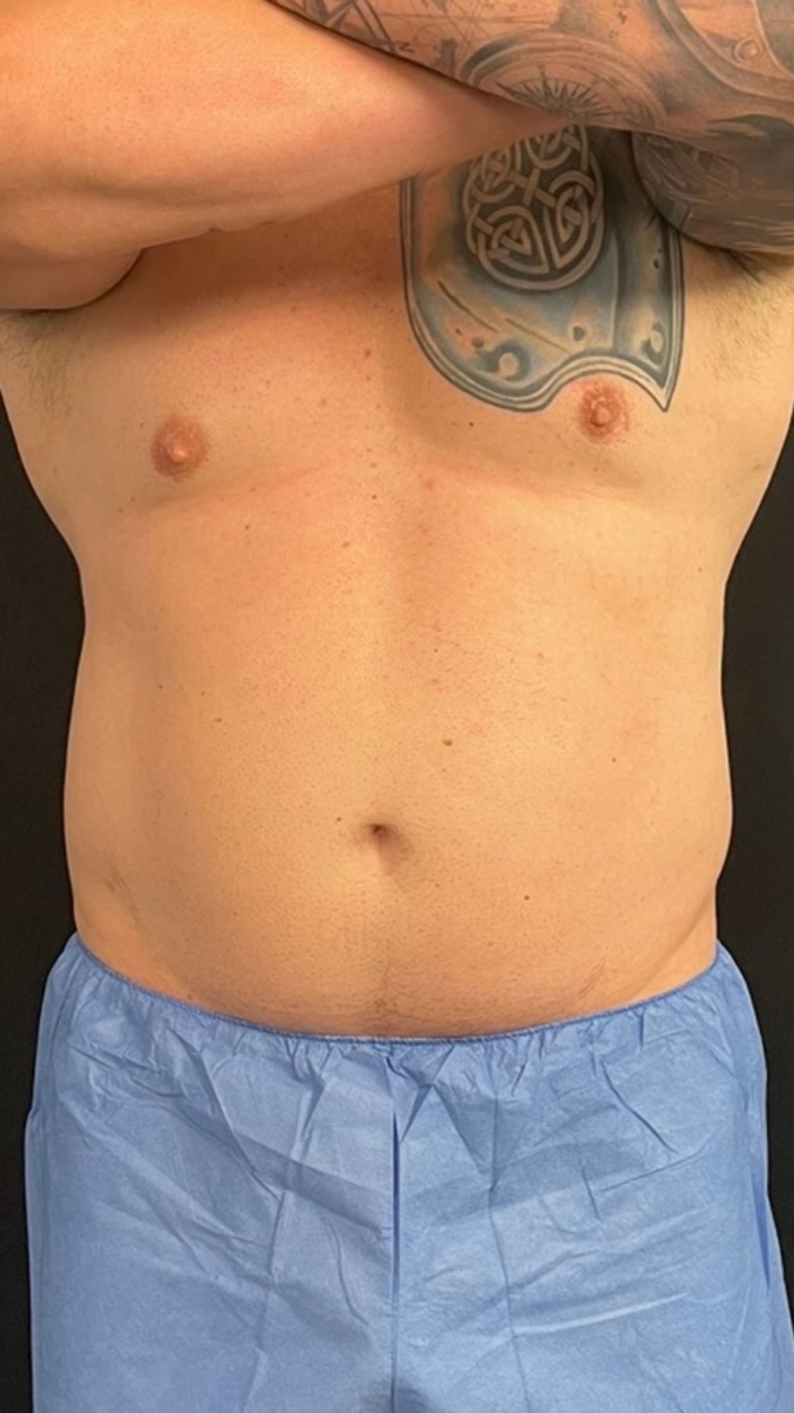 Body Contouring before and after - before