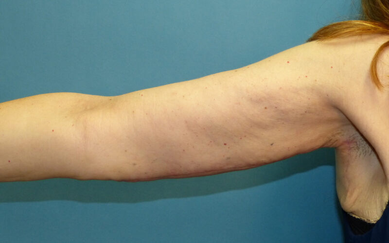 Brachioplasty before and after - after