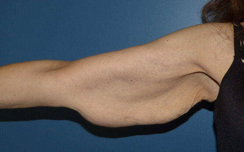 Brachioplasty before and after - before
