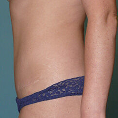 Abdominoplasty before and after - after