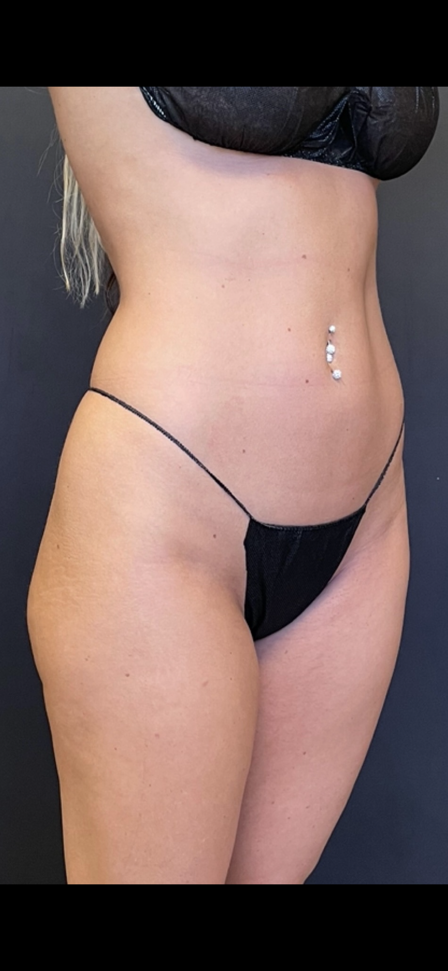 Brazilian Butt Lift before and after - before