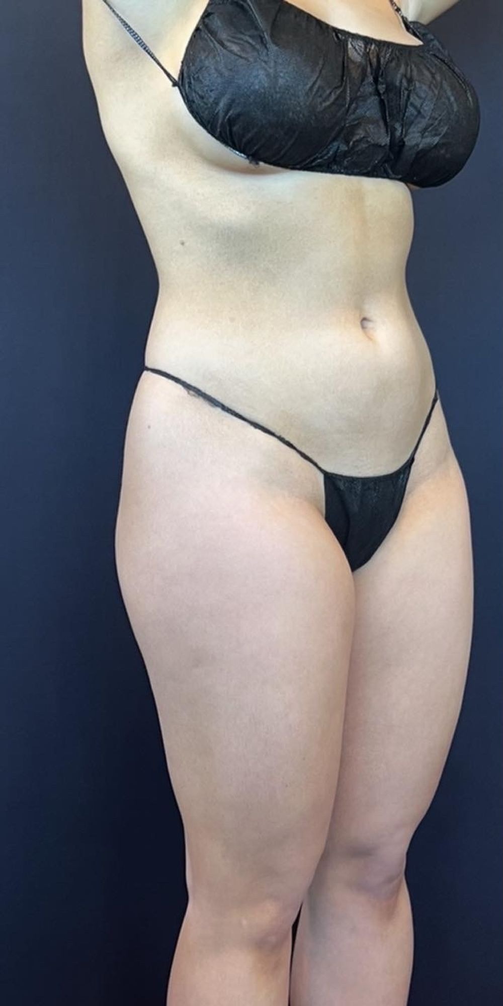 Brazilian Butt Lift before and after - before