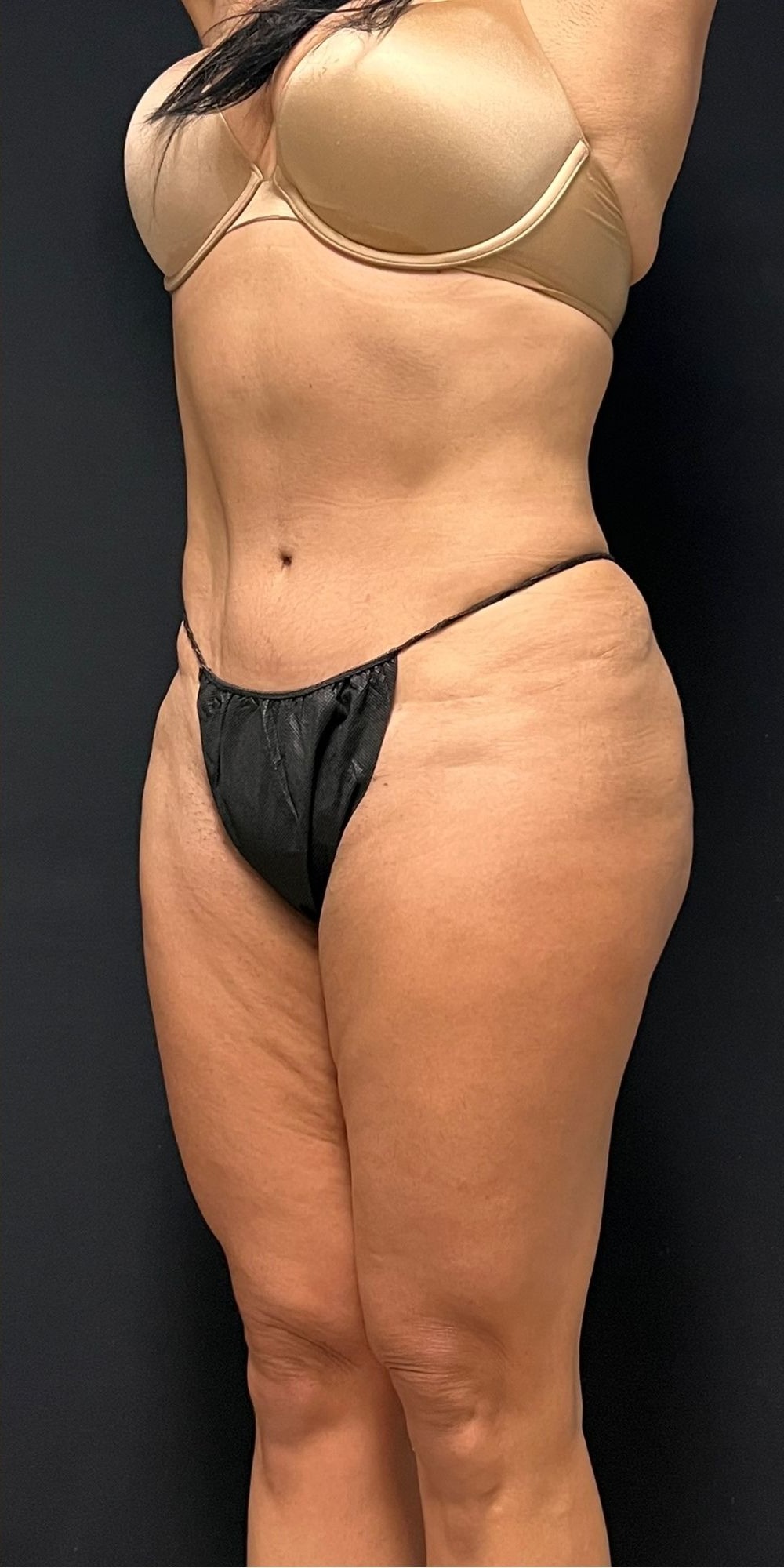 Brazilian Butt Lift before and after - after