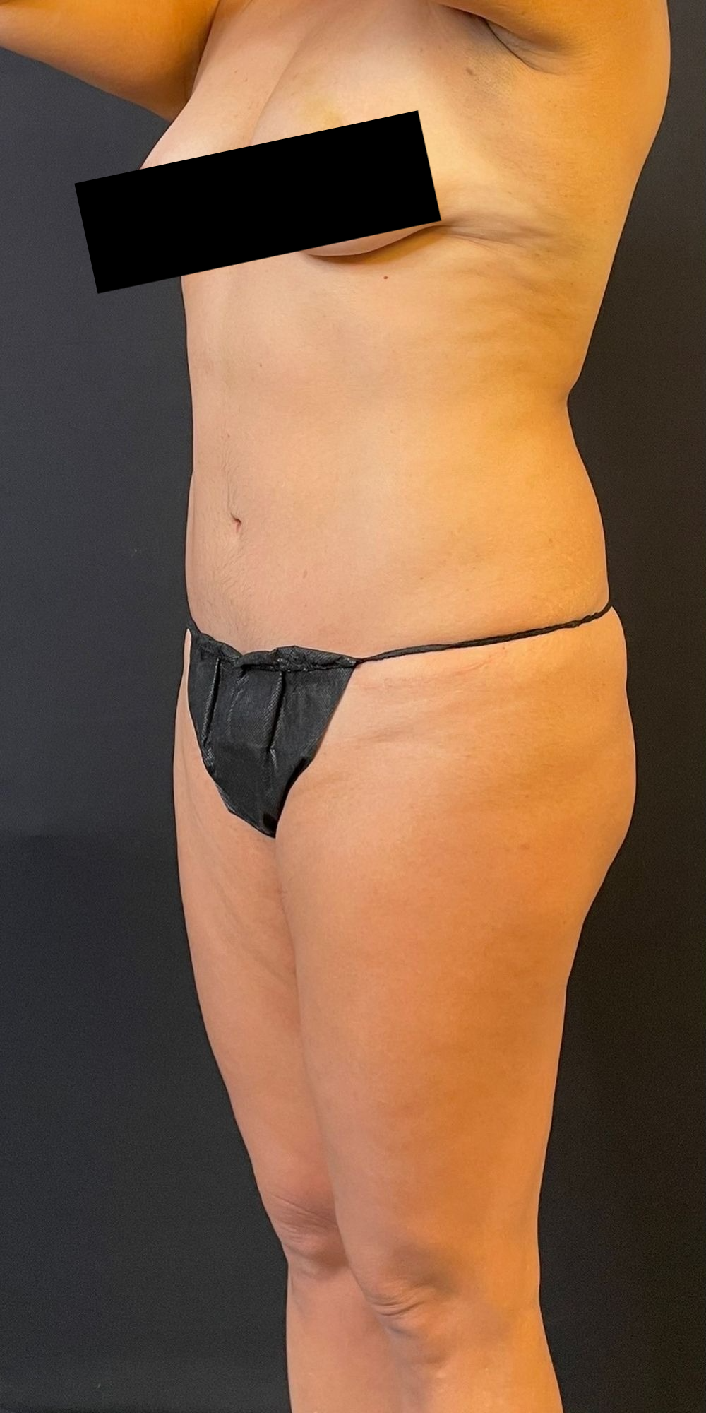 Brazilian Butt Lift before and after - before