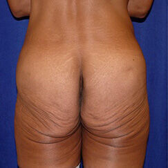 Body Lift before and after - before