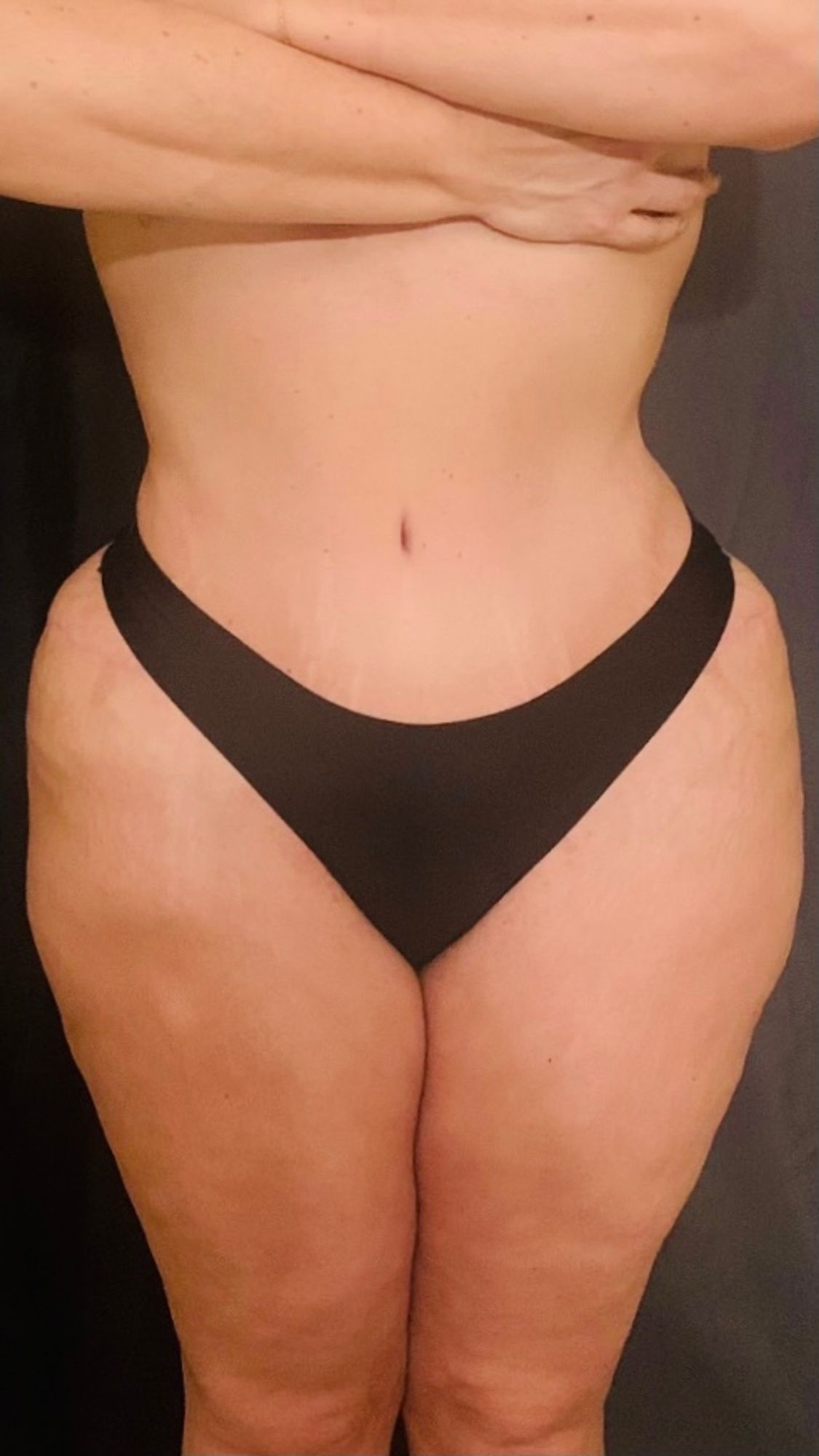 Abdominoplasty before and after - after