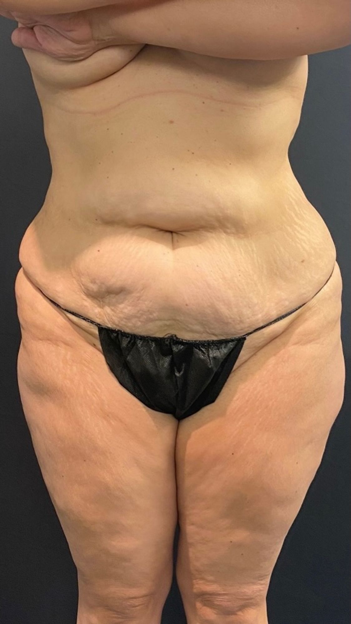 Abdominoplasty before and after - before