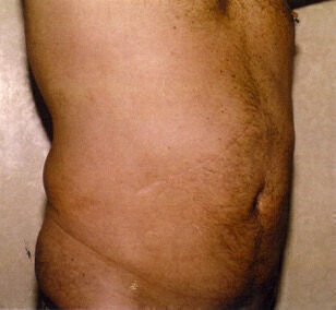 Liposuction before and after - after