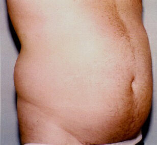 Liposuction before and after - before