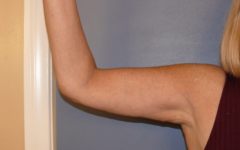 Brachioplasty before and after - after
