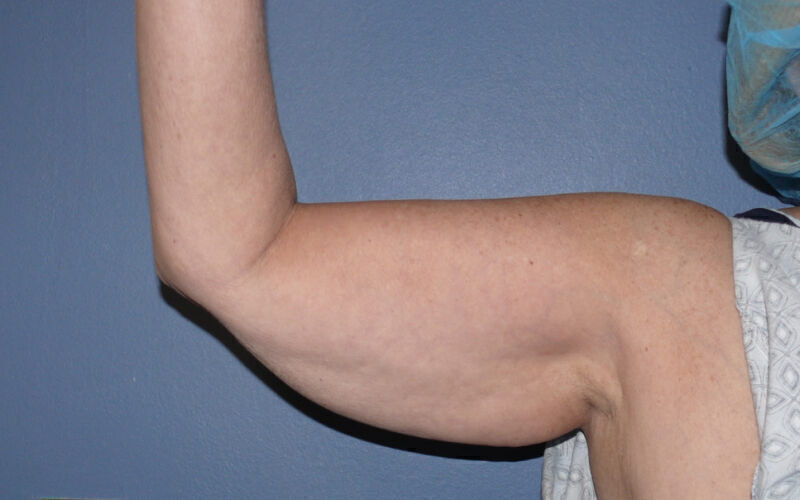 Brachioplasty before and after - before