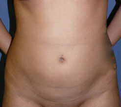 Liposuction before and after - before
