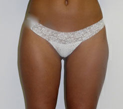 Liposuction before and after - after