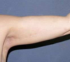 Body Contouring before and after - after