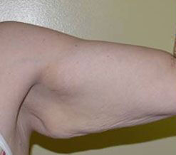 Body Contouring before and after - before