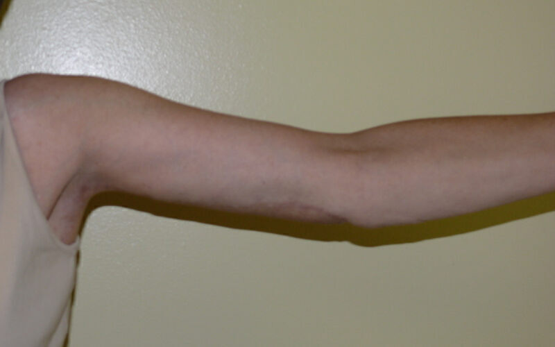 Brachioplasty before and after - after