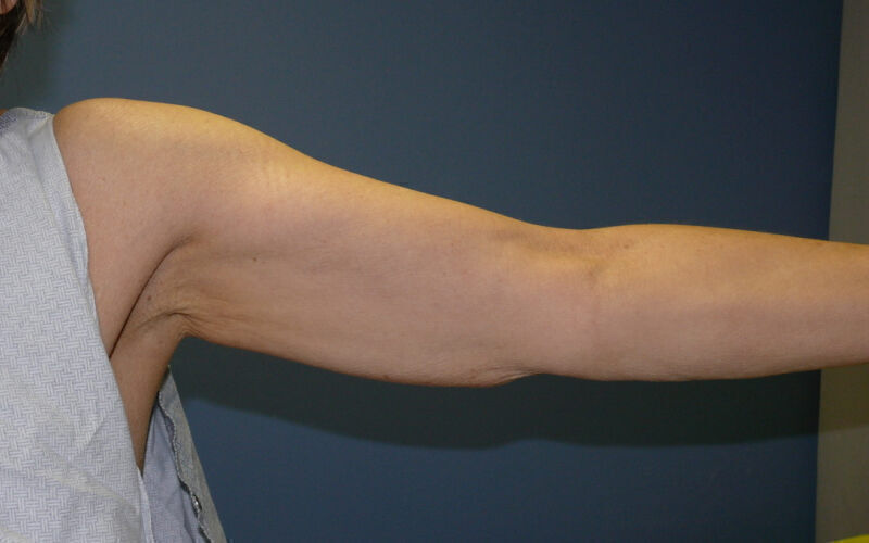 Brachioplasty before and after - before