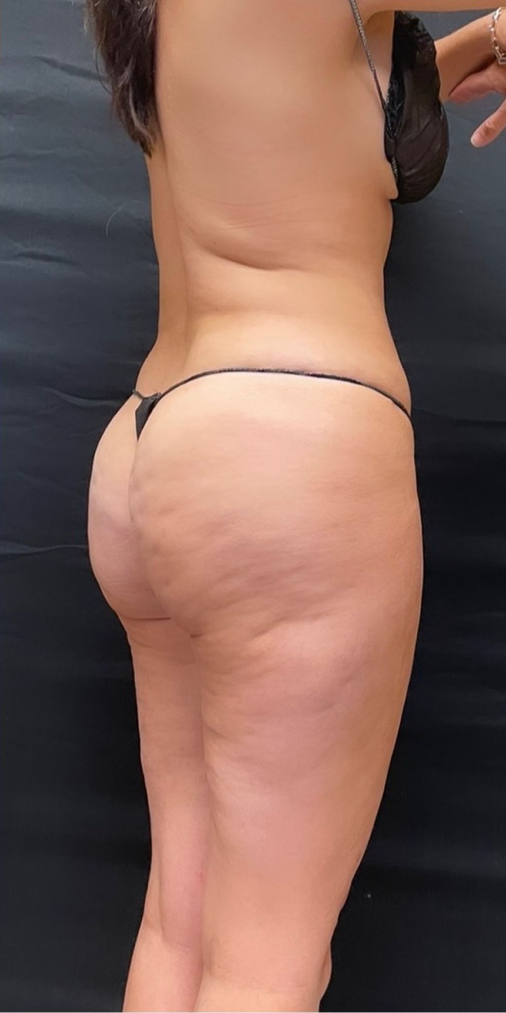Brazilian Butt Lift before and after - after