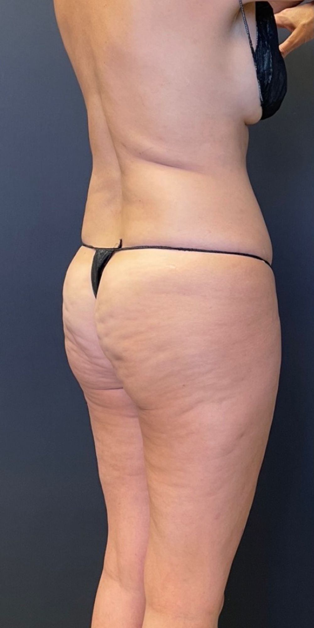 Brazilian Butt Lift before and after - before