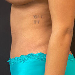 Abdominoplasty before and after - after