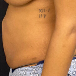 Abdominoplasty before and after - before