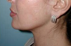Liposuction before and after - after