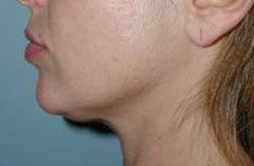 Liposuction before and after - before