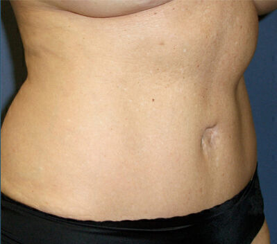 Abdominoplasty before and after - after