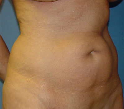 Abdominoplasty before and after - before