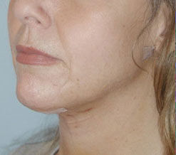 Liposuction before and after - after