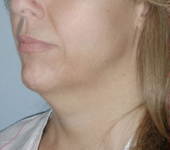 Liposuction before and after - before