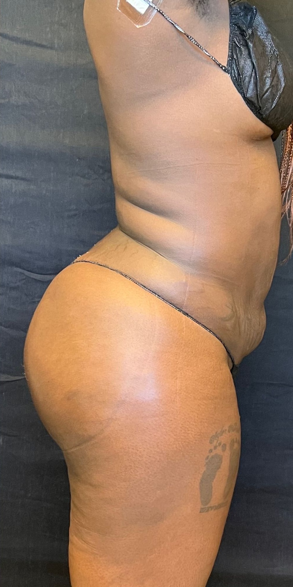 Brazilian Butt Lift before and after - after