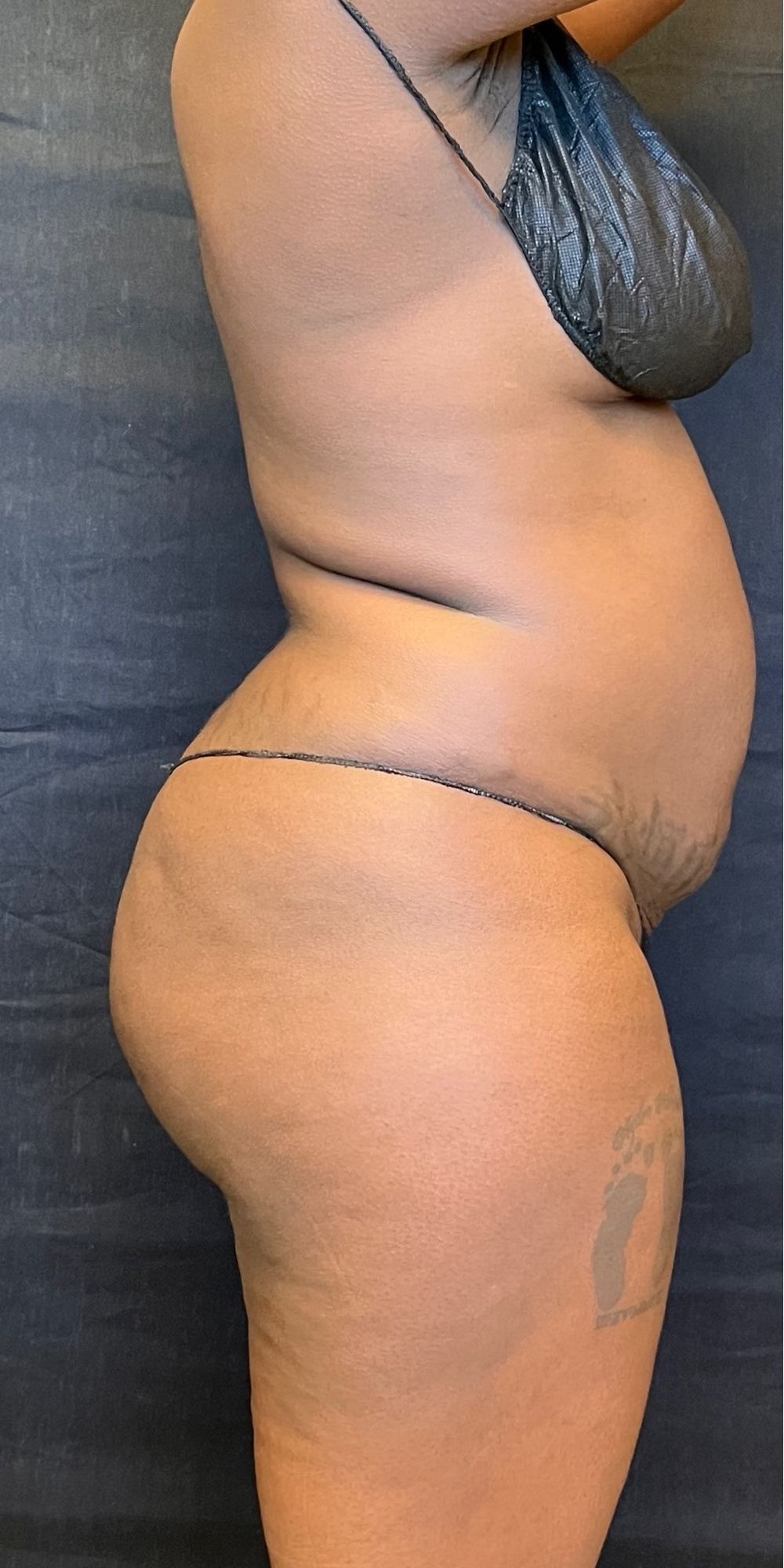 Brazilian Butt Lift before and after - before