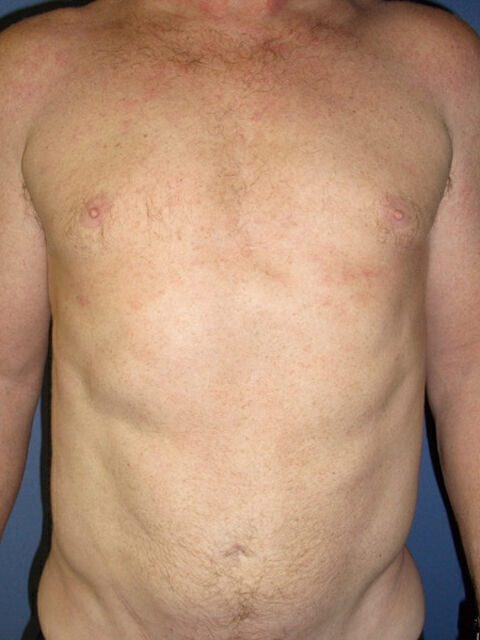 Liposuction before and after - after