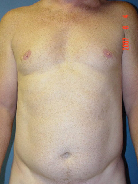 Liposuction before and after - before