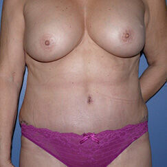 Abdominoplasty before and after - after