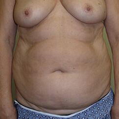 Abdominoplasty before and after - before