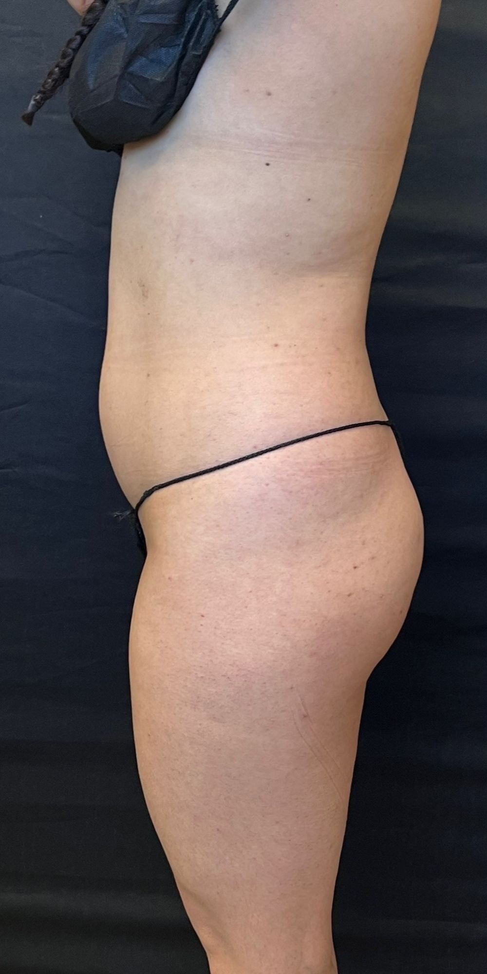 Brazilian Butt Lift before and after - before
