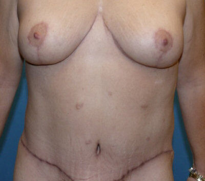 Body Contouring before and after - after