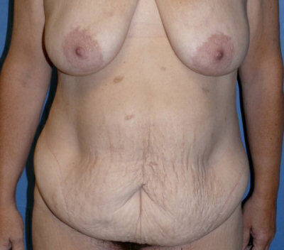 Body Contouring before and after - before