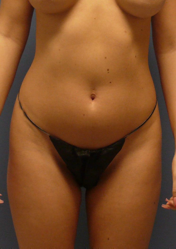 Breast Reduction before and after - before