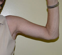 Body Contouring before and after - after