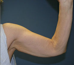 Body Contouring before and after - before