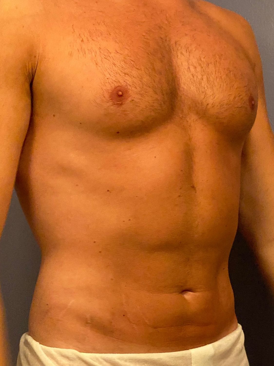Abdominoplasty before and after - after